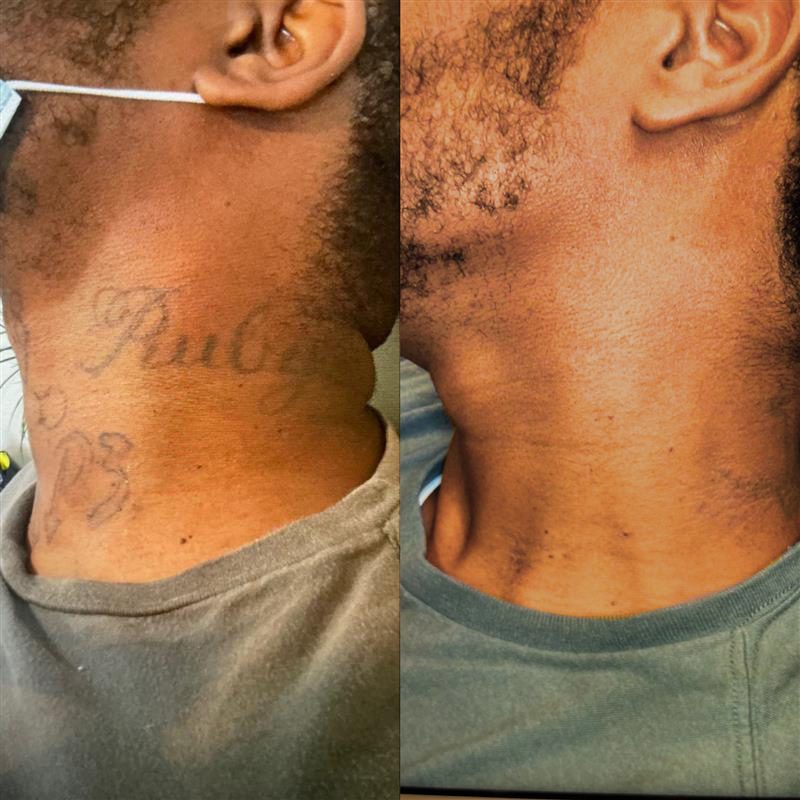 NEATCELL— Fade Tattoos & Dark Spots at Home